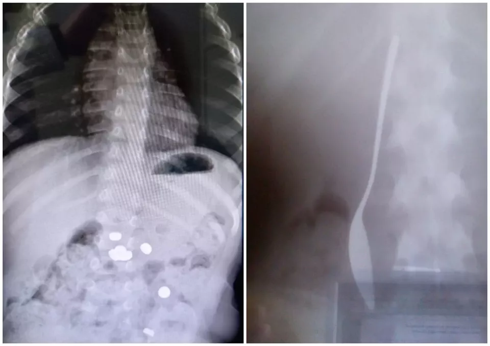 В Челябинской области ребенок проглотил 17-сантиметровую ложку