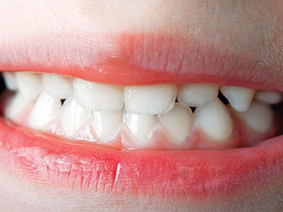 Как уберечь зубки ребенка от кариеса?