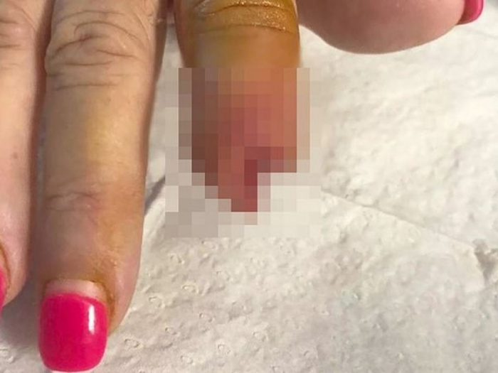 Женщине ампутировали фалангу пальца после маникюра
