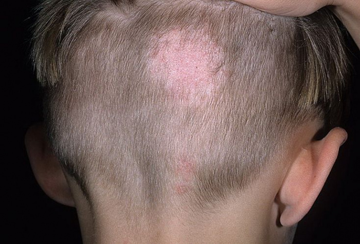 Из-за неправильного диагноза 3-летнему ребенку пришлось вырывать волосы