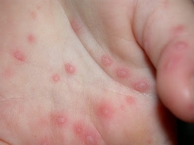Под маской аллергии: в Копейске выявлен вирус, атакующий малышей