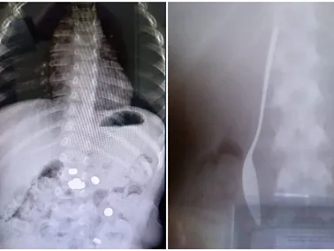 В Челябинской области ребенок проглотил 17-сантиметровую ложку